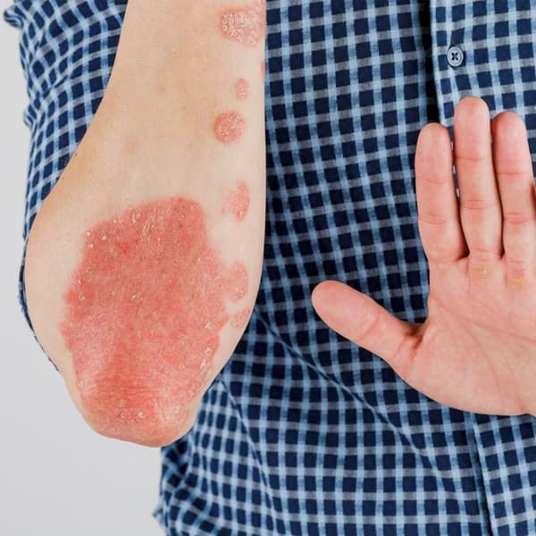 Arm showing plaque psoriasis patches