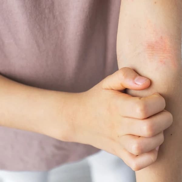 Child scratching an arm affected by atopic dermatitis