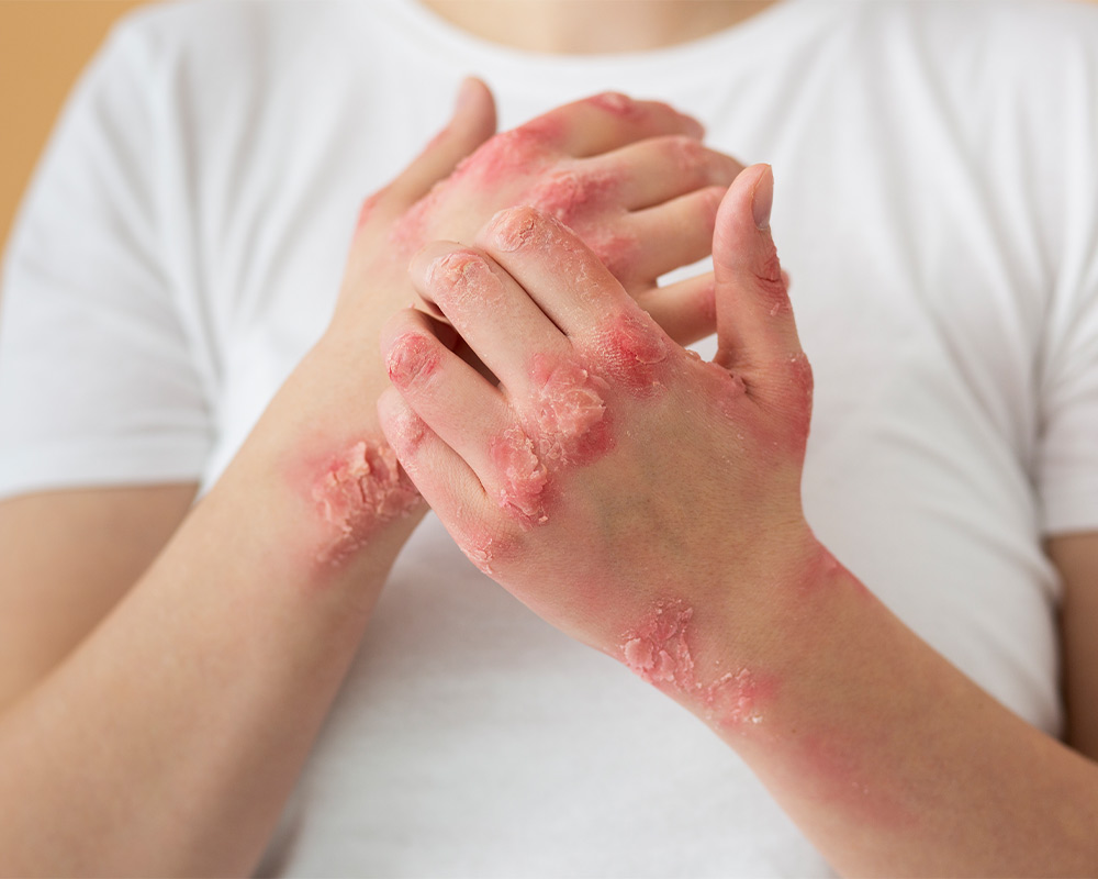 eczema