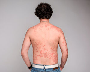Erythrodermic psoriasis